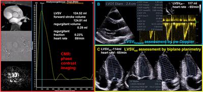 Plausible Functional Diagnostics by Rational Echocardiography in the Assessment of Valvular Heart Disease - Role of Quantitative Echocardiography in the Assessment of Mitral Regurgitation